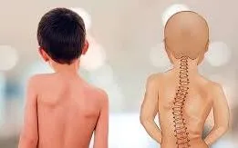 Bệnh viện Việt Đức khám, tư vấn miễn phí tầm soát gù vẹo cột sống cho trẻ em ngày 4/4