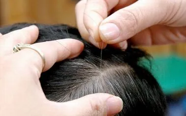 Ăn nhiều đường, muối, rượu bia: Nguy cơ khiến tóc bạc sớm