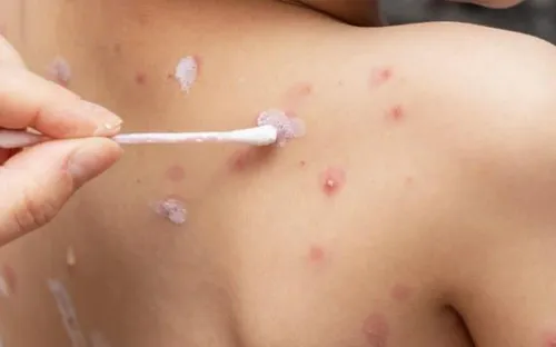 Nghệ An: Gia tăng ca thủy đậu, cảnh báo phụ huynh phát hiện sớm để tránh biến chứng