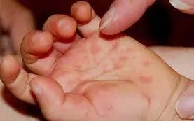 Hơn 25.000 ca tay chân miệng, Bộ Y tế yêu cầu tăng cường thu dung, điều trị và kiểm soát dịch