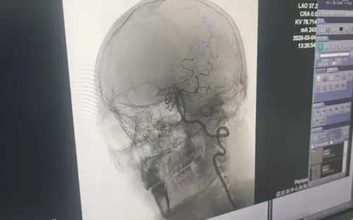 Massage mạnh vùng cổ, người đàn ông bị đột quỵ và liệt nửa người