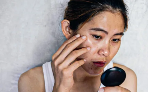 Vì sao da sạm nám khi trời nắng?