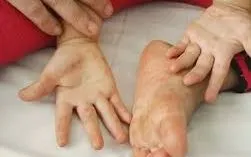 Hà Nội ghi nhận 275 ca tay chân miệng trong một tuần, cảnh báo nguy cơ dịch lan rộng