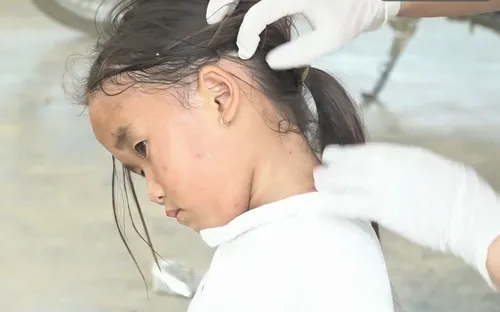 Đắk Lắk: Không để dịch thuỷ đậu lây lan ra cộng đồng