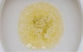 Nước tiểu có bọt lâu tan: Dấu hiệu cảnh báo tổn thương thận