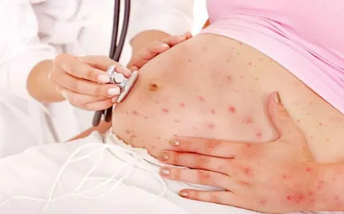 Gia tăng ca thủy đậu ở phụ nữ mang thai, cảnh báo nguy cơ cho mẹ và thai nhi