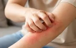 5 dấu hiệu bất thường trên da cảnh báo gan suy yếu dễ bị bỏ qua