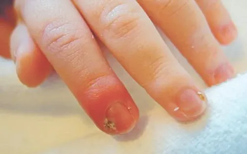 Chín mé ngón tay: Không tự ý đắp thuốc lá