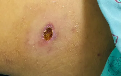 Cảnh giác với sốt mò: Bệnh dễ nhầm cảm cúm nhưng có thể gây biến chứng nguy hiểm