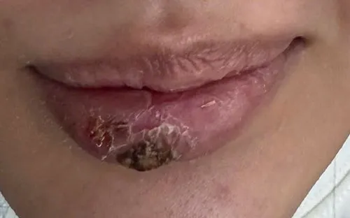 Cô gái trẻ suýt hoại tử môi sau tiêm tan filler tại spa không phép