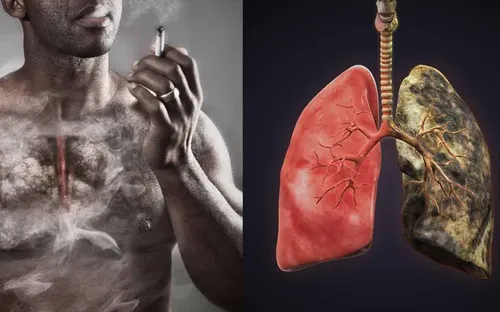 Người từng hút thuốc vẫn có nguy cơ ung thư phổi dù đã cai thuốc
