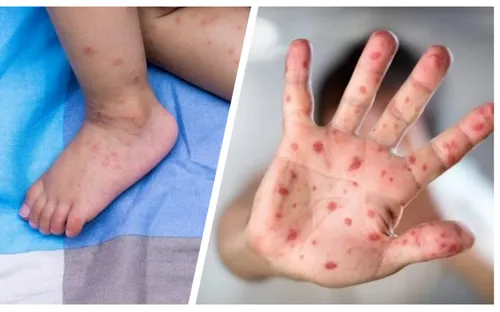 Hà Nội: Tay chân miệng giảm, sốt xuất huyết có xu hướng gia tăng trở lại