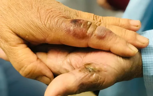 Bắt buộc nhập viện khi có dấu hiệu tổn thương nặng do côn trùng độc