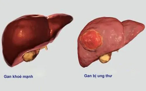 Ung thư gan âm thầm nhưng nguy hiểm: Người thuộc nhóm nguy cơ cao cần làm gì để phòng bệnh?