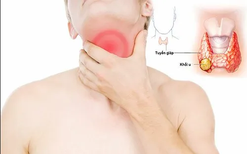 Ung thư tuyến giáp ngày càng trẻ hóa: Dấu hiệu nhận biết sớm và cách phòng ngừa hiệu quả