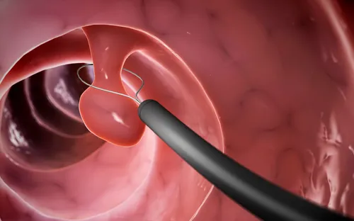 Polyp mũi có nguy hiểm không? Những điều nhiều người thường bỏ qua