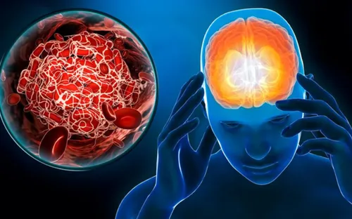 Nắng nóng kéo dài, chuyên gia cảnh báo những dấu hiệu đột quỵ cần nhận biết sớm để cứu sống người bệnh
