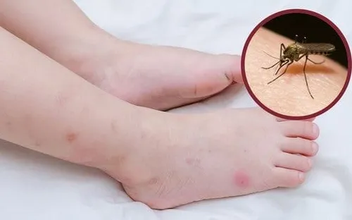Mẹo đơn giản giúp giảm ngứa ngáy do muỗi đốt hiệu quả tại nhà