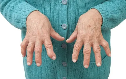 Đừng xem nhẹ viêm khớp: Những biến chứng nguy hiểm có thể dẫn đến tàn phế