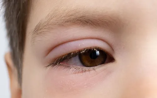 Cách phòng tránh bệnh đau mắt đỏ hiệu quả trong mùa cao điểm