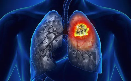 Không hút thuốc nhưng vẫn có nguy cơ mắc ung thư phổi: Những nguyên nhân ít người ngờ tới
