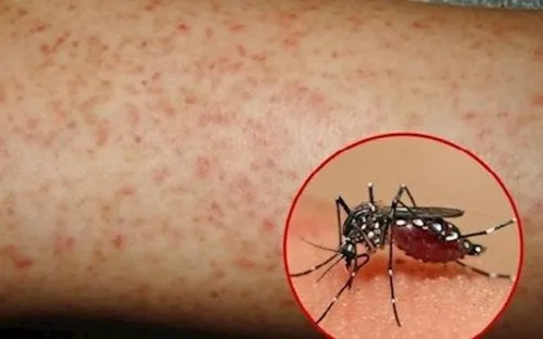 Bác sĩ cảnh báo 2 sai lầm nguy hiểm có thể khiến bệnh nhân sốt xuất huyết trở nặng