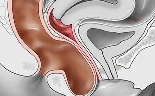 Sa trực tràng có nguy hiểm không? Những biến chứng có thể xảy ra nếu chậm điều trị