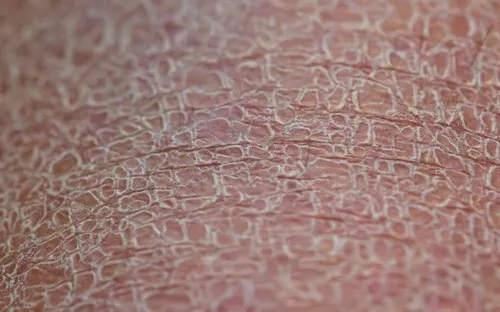 Bệnh hiếm khiến làn da liên tục bong tróc: Đừng chủ quan khi da khô, nứt nẻ kéo dài