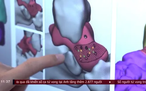 Kỳ tích y khoa: Thay xương sên bằng công nghệ in 3D cứu thanh niên khỏi nguy cơ tàn phế