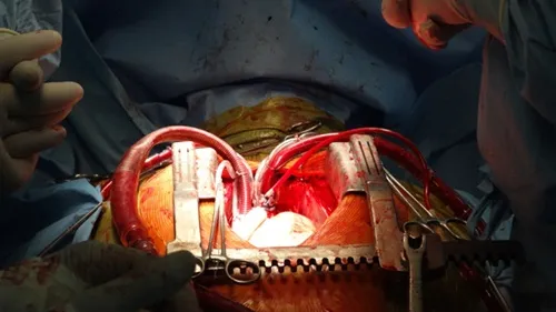 Lần đầu tiên thực hiện cấy tim nhân tạo ở Việt Nam