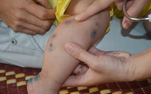 Bệnh sốt xuất huyết và tay chân miệng tăng cao ở Đà Nẵng