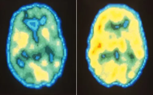 Trầm cảm sau kết hôn Một nghịch lý?
