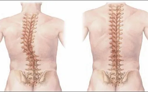 Phát hiện sớm chứng vẹo cột sống ở trẻ em