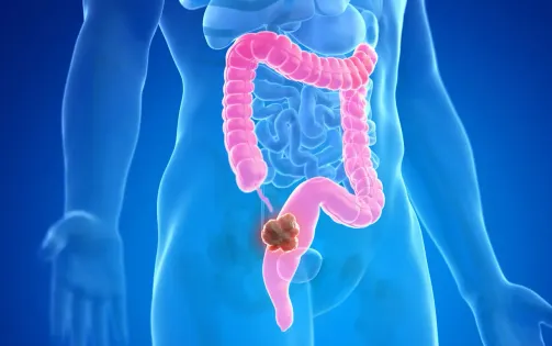 Phát hiện yếu tố làm tăng nguy cơ ung thư đại tràng ở người trẻ