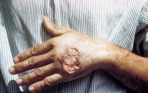 Thái Lan cảnh báo bệnh nhiễm ký sinh trùng Leishmania gây tử vong