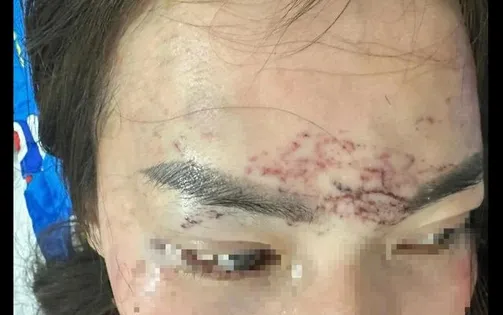 Khởi tố vụ án người phụ nữ bị tạt axit, xăm lên mặt do ghen tuông