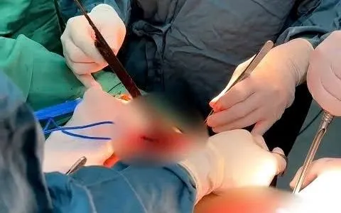 Quảng Bình: Cứu sống nam thanh niên bị thanh gỗ đâm xuyên ngực