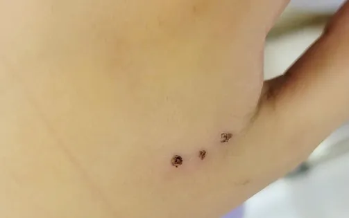 Vết cắn nhỏ - hiểm họa lớn từ chuột
