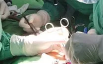 Cứ ngỡ trào ngược dạ dày, hóa ra u tuyến ức chèn ép trong lồng ngực