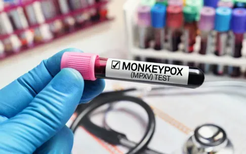 Nam Phi báo cáo trường hợp tử vong thứ hai do mpox (đậu mùa khỉ) trong tuần