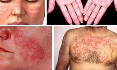 Nhận diện căn bệnh Lupus ban đỏ hệ thống