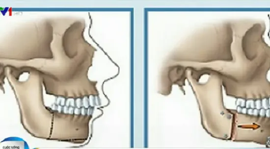 Trẻ em niềng răng tốt nhất ở tuổi 12