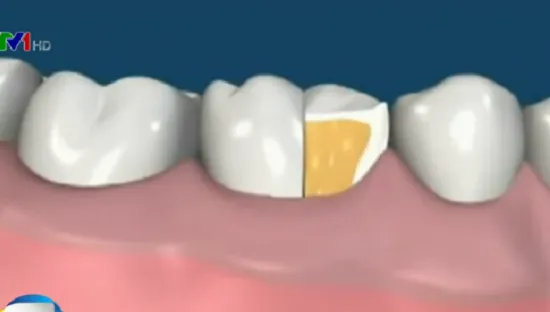 Cần lưu ý chế độ ăn uống và khám định kỳ khi bọc răng sứ