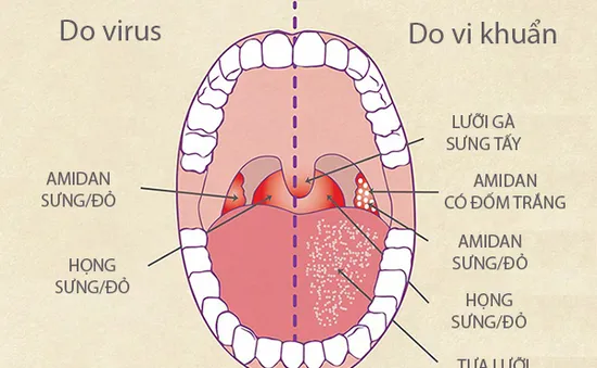 Kháng sinh không phải phao cứu sinh với bệnh viêm họng virus