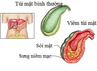 Đừng xem nhẹ bệnh viêm túi mật