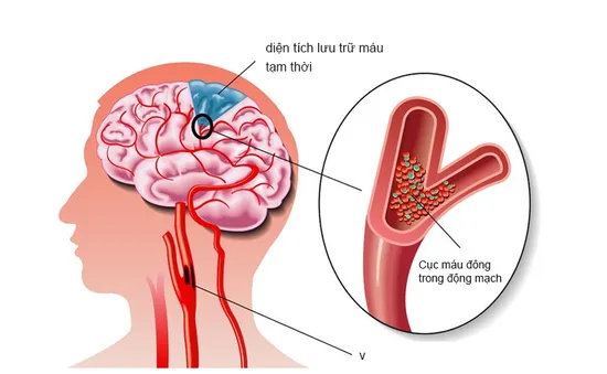 Thiếu máu não - Kẻ "giết người" thầm lặng