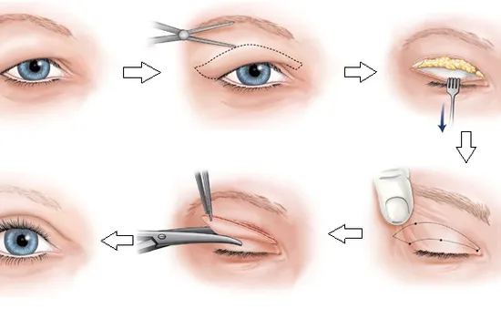 Phẫu thuật tạo hình mí mắt không hề đơn giản