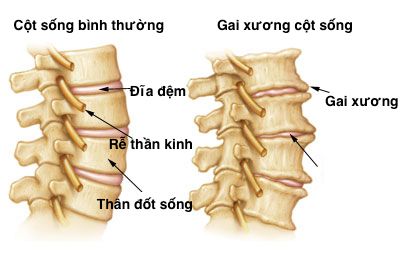 Điều trị bệnh gai cột sống bằng vật lý trị liệu