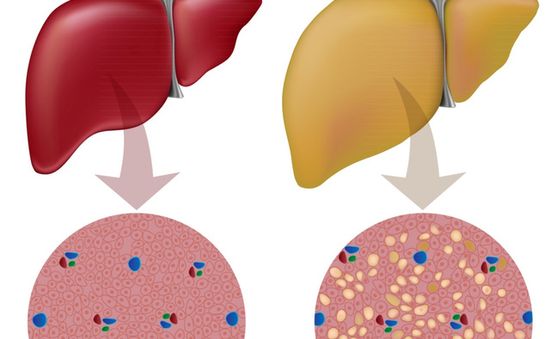 Gan nhiễm mỡ - Sát thủ thầm lặng khó nhận biết