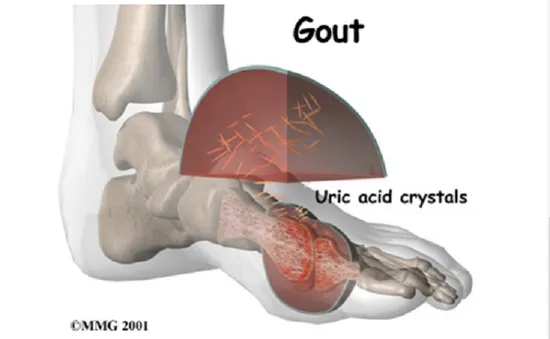 Vì sao bệnh gout bùng phát mạnh vào mùa xuân?